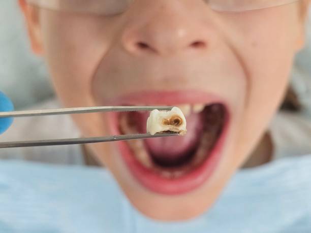 Best Emergency Wisdom Tooth Extraction in Ogdensburg, NJ
